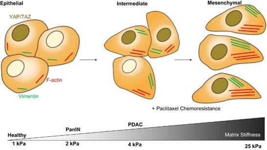 Matrix sDtiffness induces epithelial–mesenchymal transition and promotes chemoresistance in pancreatic cancer cells